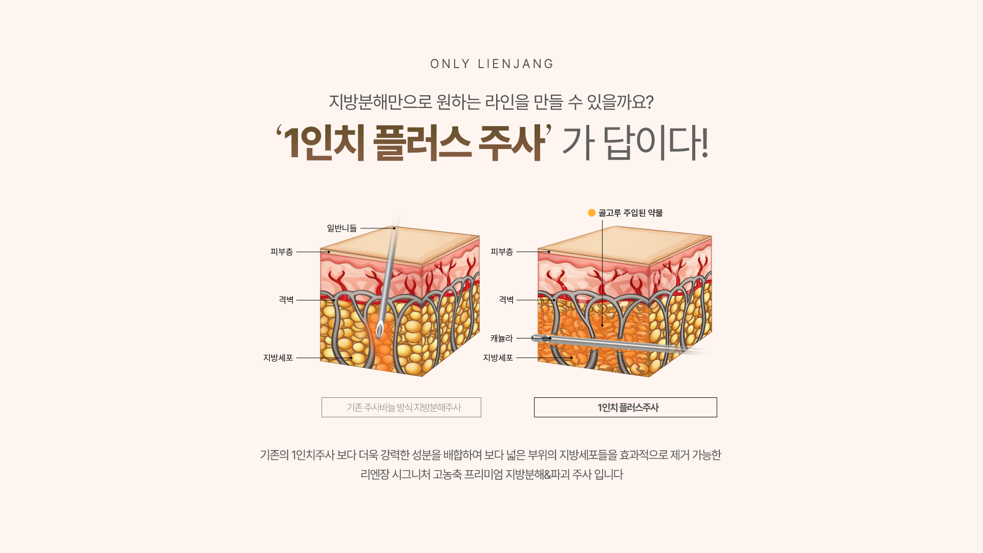 리엔장 1인치 플러스주사 시술 설명