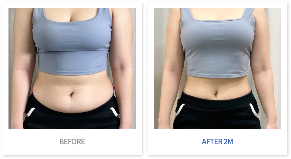 바디 시술 전후 비교 1