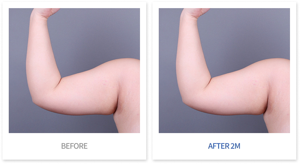 바디 시술 전후 비교 6