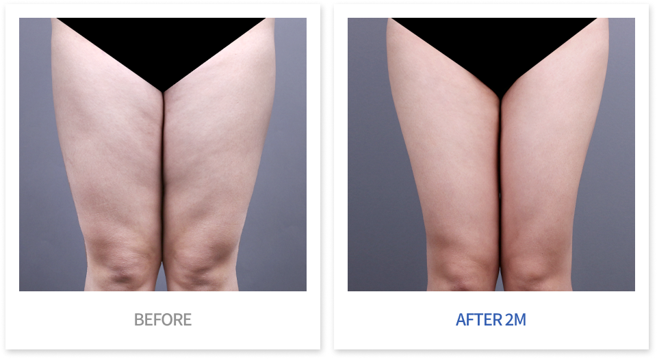 바디 시술 전후 비교 7