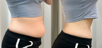 바디 시술 전후 썸네일 1