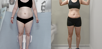 바디 시술 전후 썸네일 3