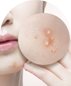 리엔장 여드름케어 집중 솔루션 설명 이미지 - 개인별 솔루션