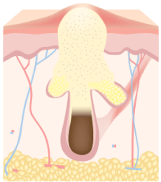 리엔장 여드름케어 여드름 발생 이미지