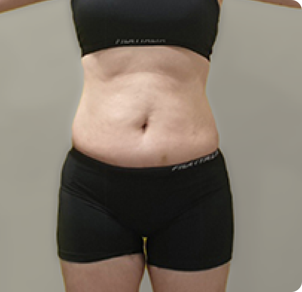 복부전체, 러브핸들 시술 후