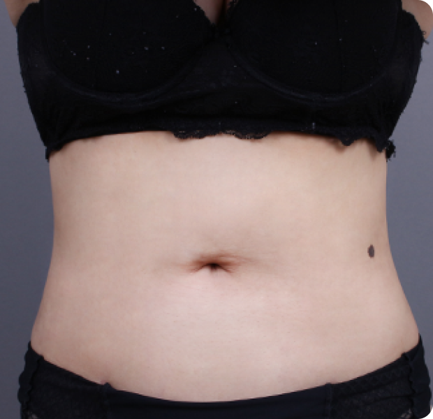 복부전체 시술 후