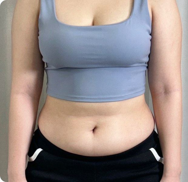 복부전체, 러브핸들, 뒷구리, 허벅지 시술 전