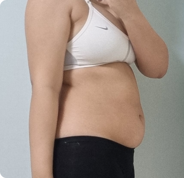 복부전체, 러브핸들 시술 전