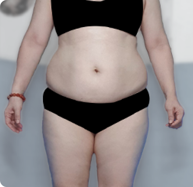 복부전체, 러브핸들 시술 전