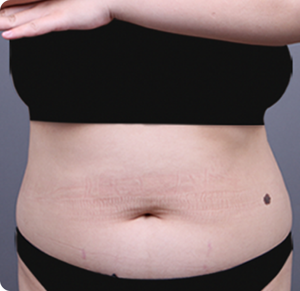 복부전체 시술 전