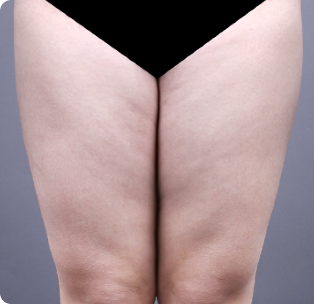 허벅지 시술 전