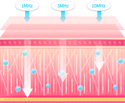 리엔장 LDM 물방울 리프팅 원리 이미지 - 1MHz, 3MHz, 10MHz 초음파 주파수로 피부층별 맞춤 케어
